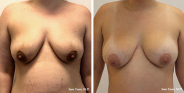 Breast Augmentation Before and after