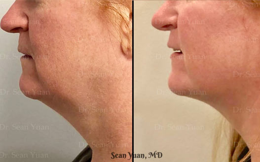 Before and after Chin Lipo