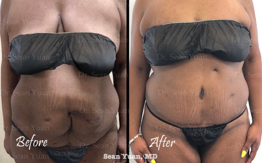 Before and after Tummy Tuck surgery