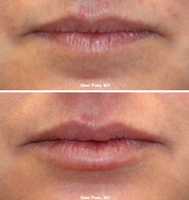 Lip Augmentation Before and after