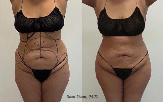 Liposuction and BBL Before and after