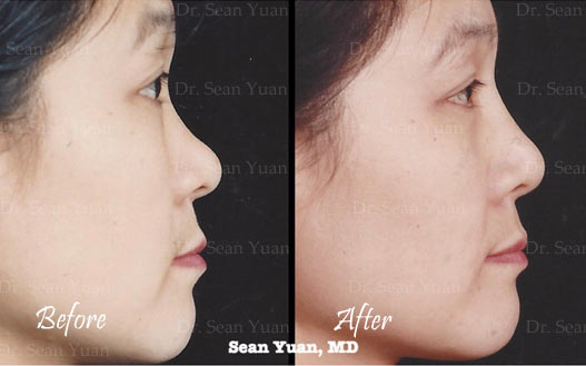 Nasal bridge augmentation Before and after
