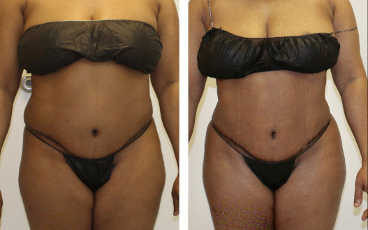 Liposuction of love handle Before and after