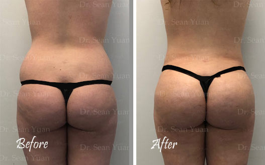 Love Handle Liposuction Before and after