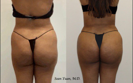 Liposuction and Fat Transfer Before and after