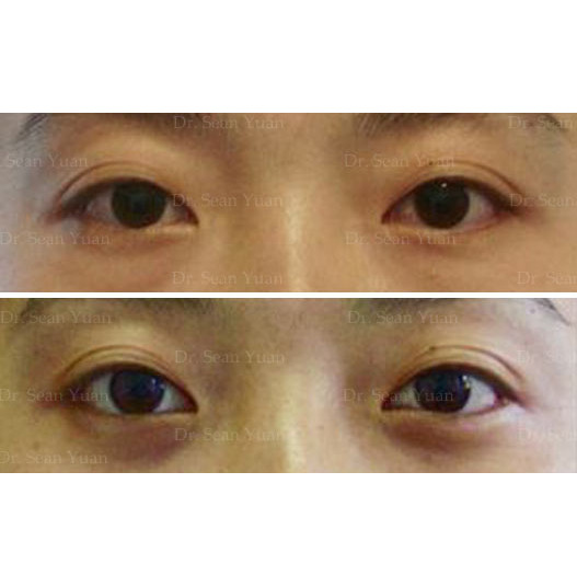 Before and After lower Eyelid Surgery