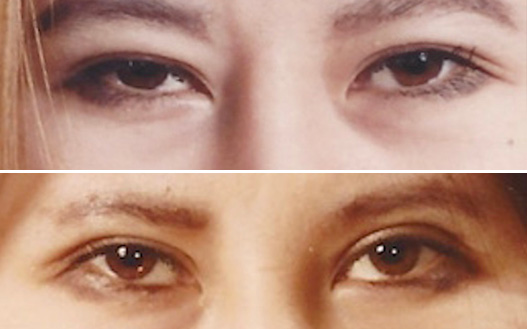 Before and After Upper Eyelid Surgery