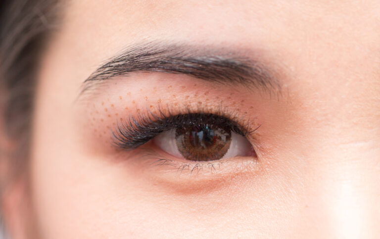 Cosmetic procedure to strengthen the skin of the eyelids