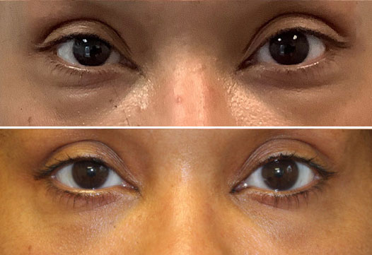 Lower Eyelid Before and After