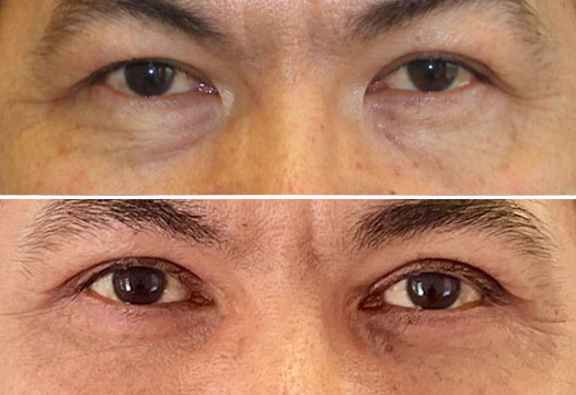 Lower-Eyelid-Before-and-After